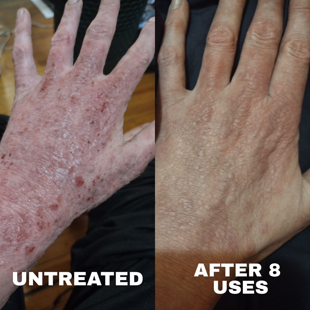Antes y después brazo