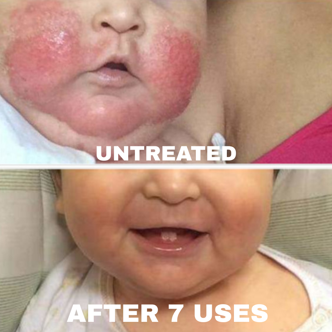 Resultados eczema