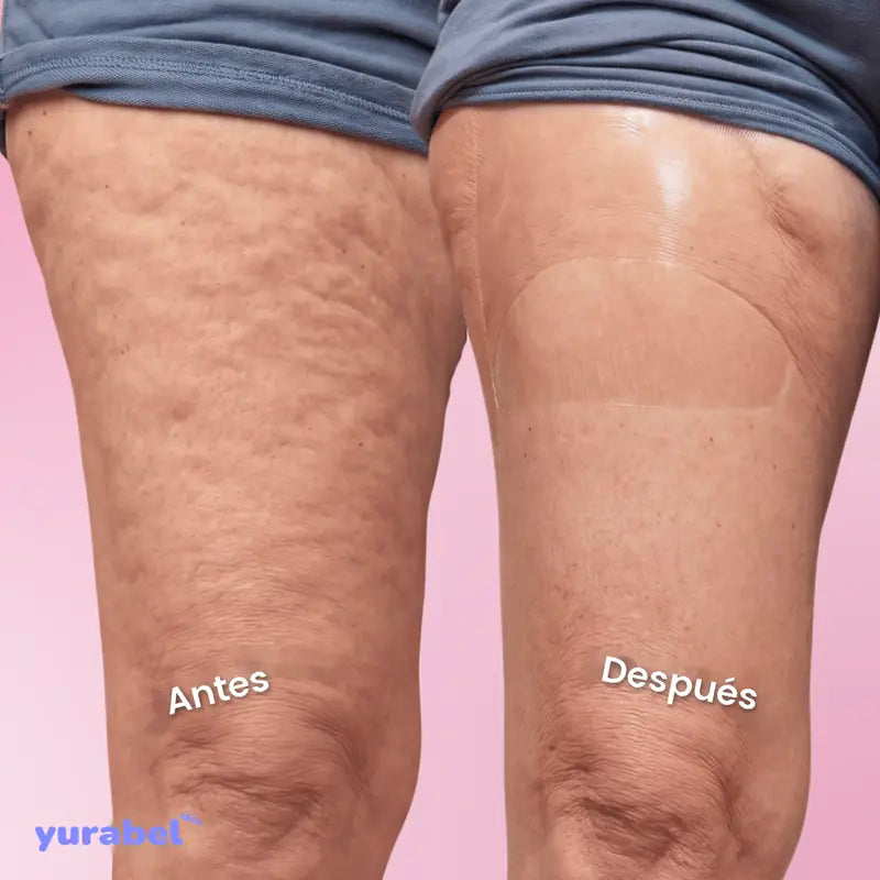 Antes y después con la cinta lifting